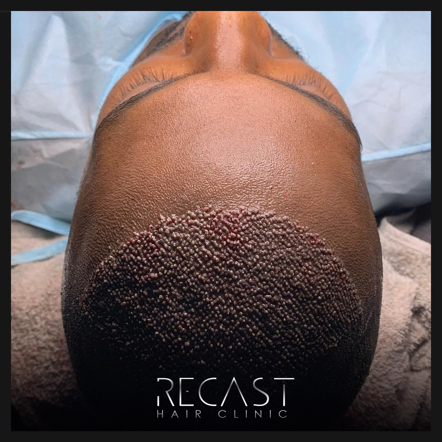 Afro Hair Transplant