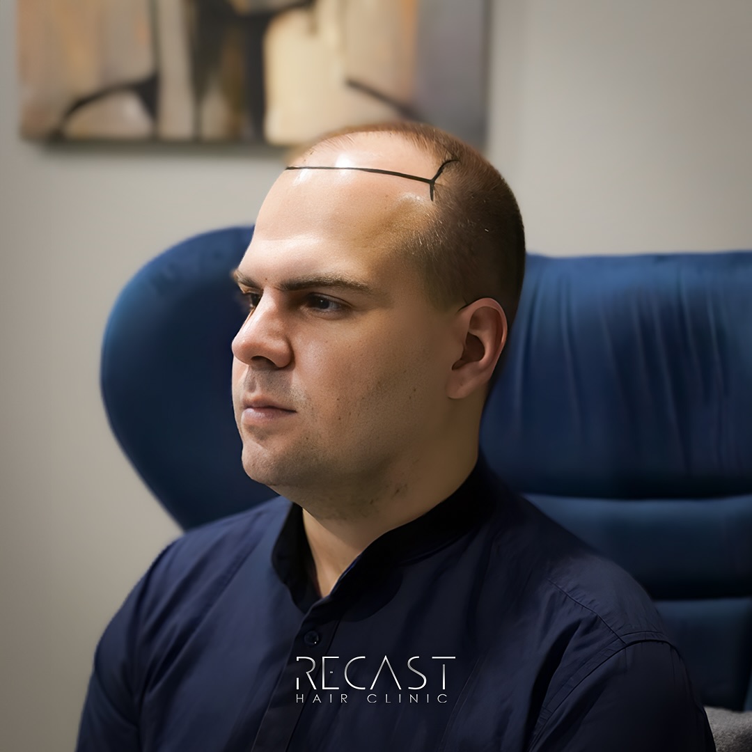 Shaved Hair Transplant