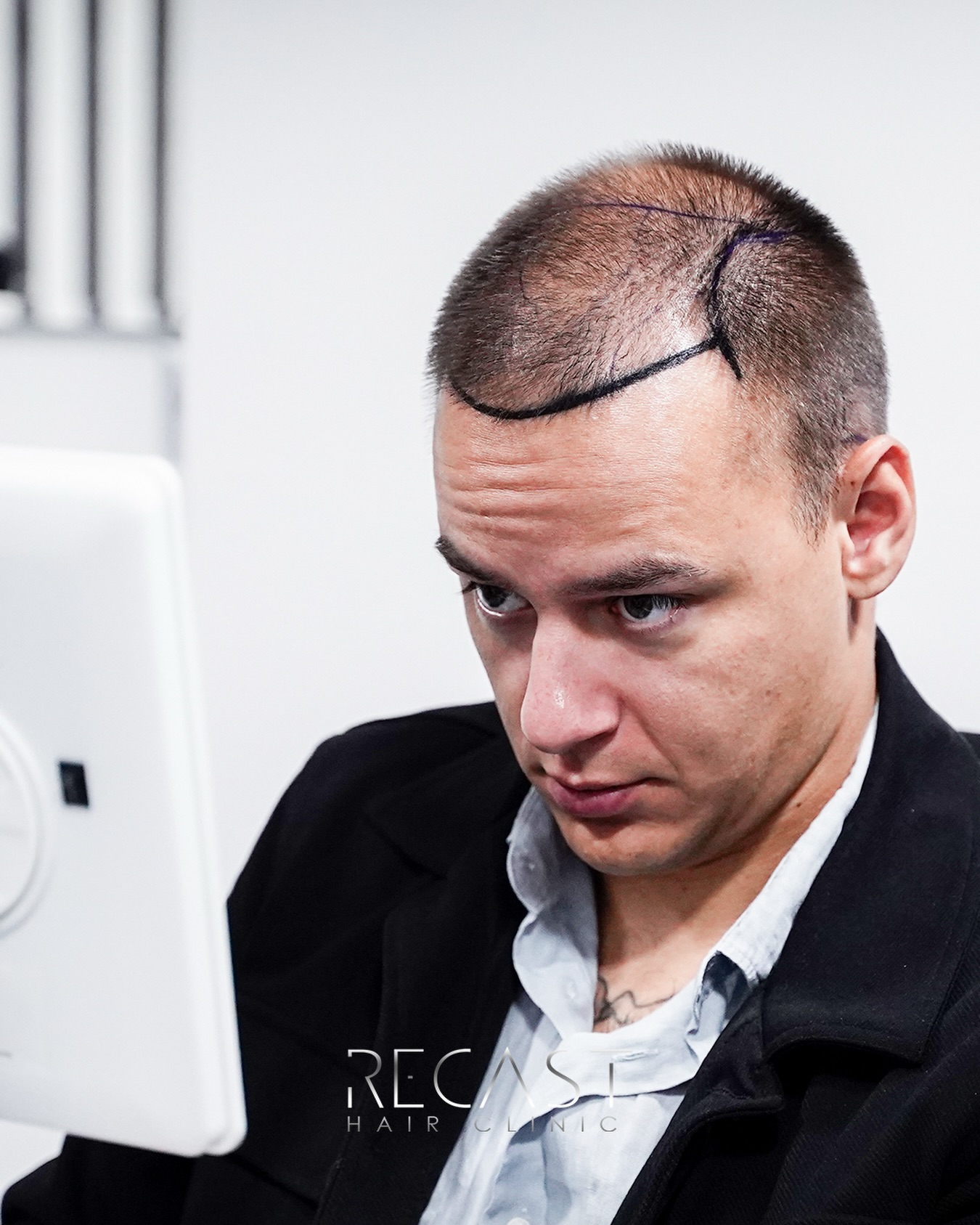 Unshaved Hair Transplant