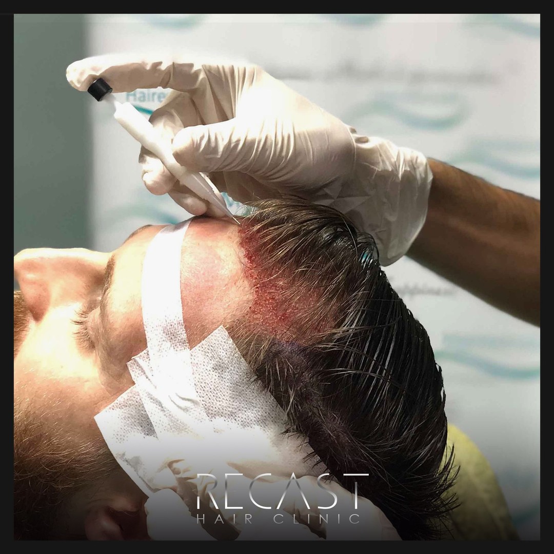 Temple Hair Transplant