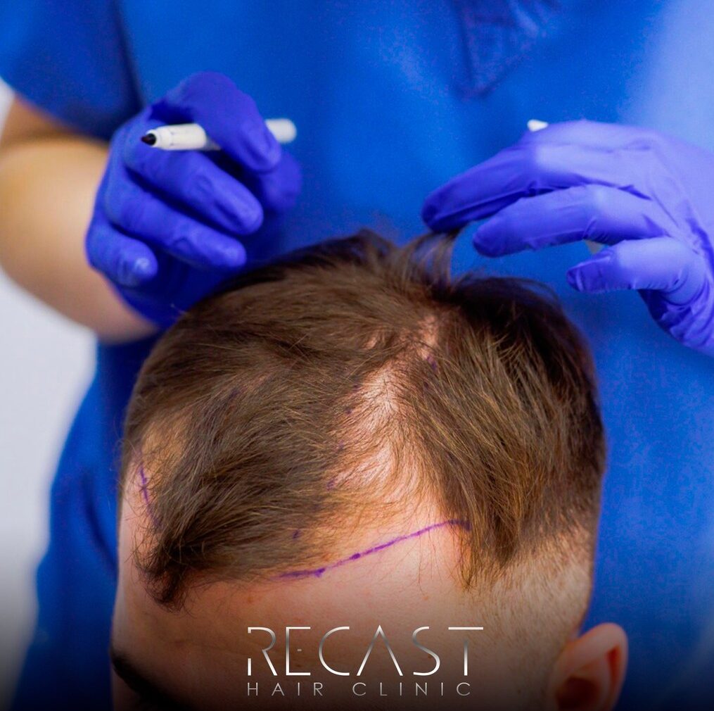 Medical Hair Loss Treatment