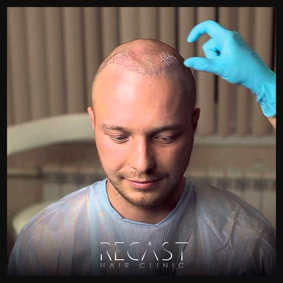 Hair Transplant Aftercare