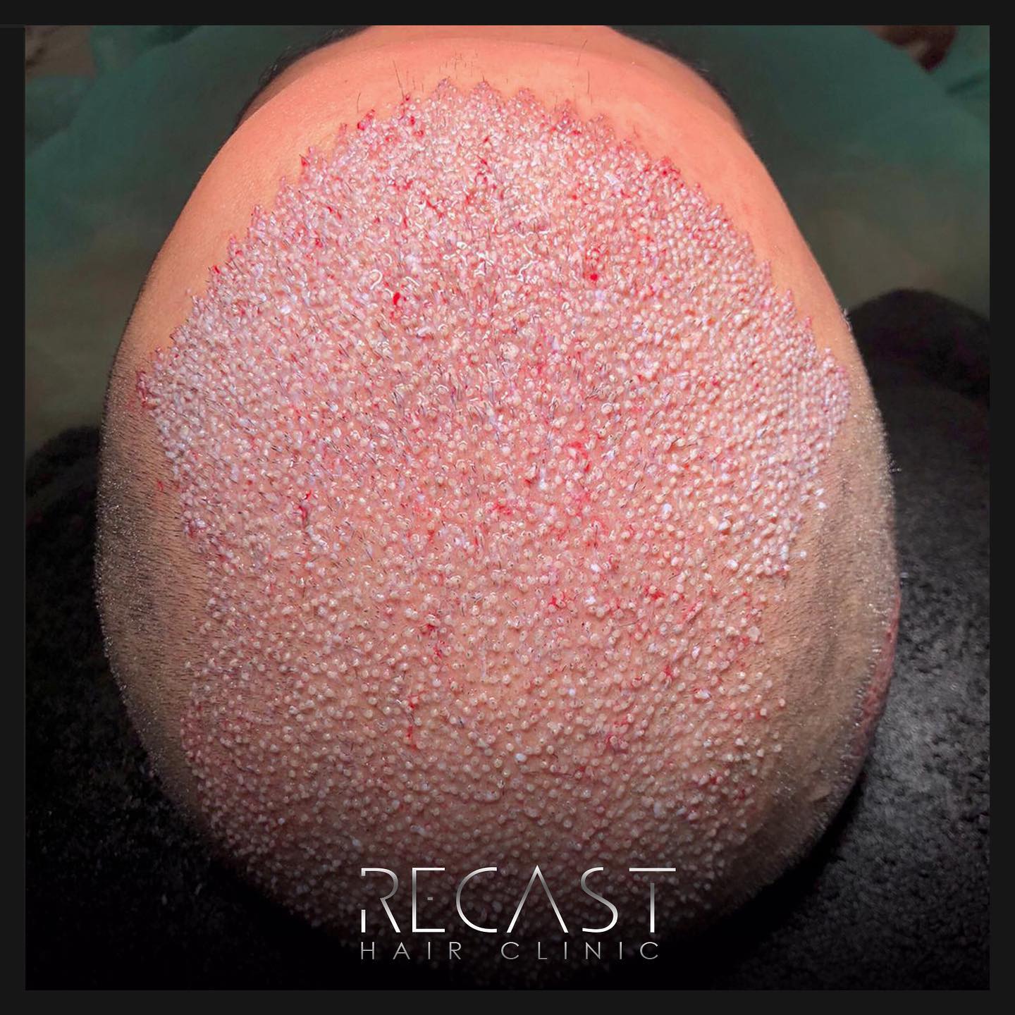 Vertex Hair Transplant