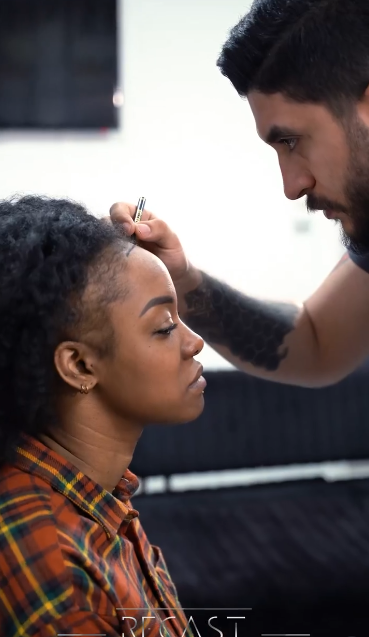 Hair Transplant for Women