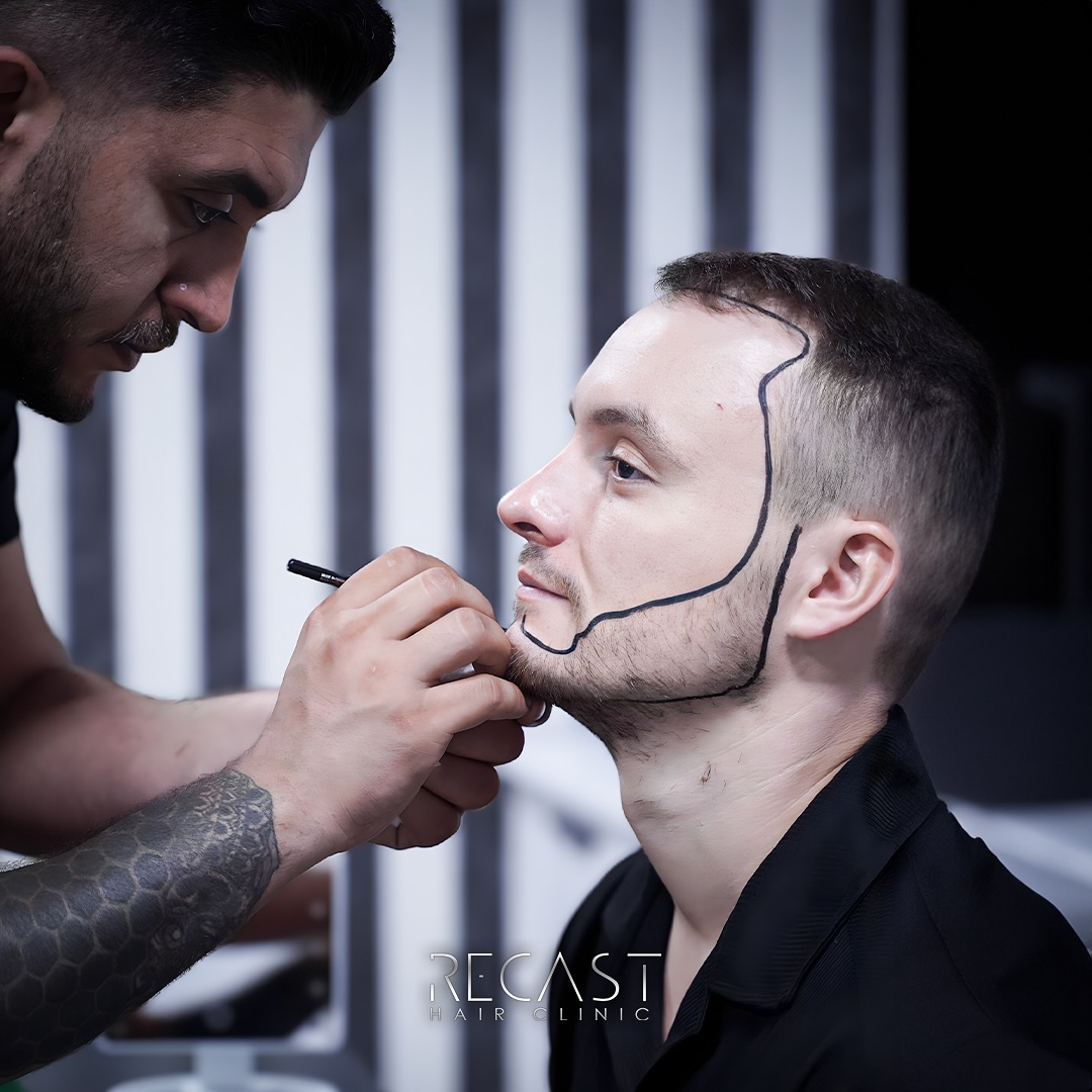 Hair Transplant Guide - Tips and Knowledge